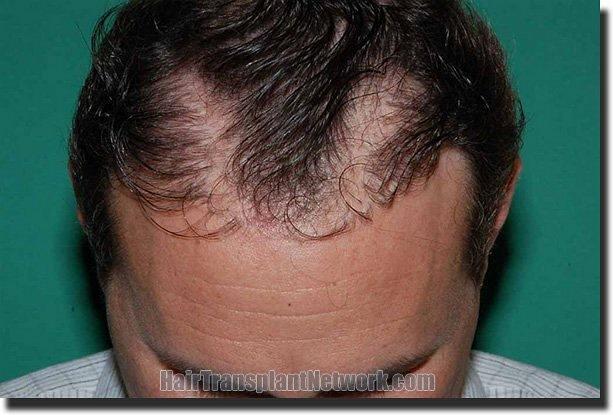 Hair restoration procedure results