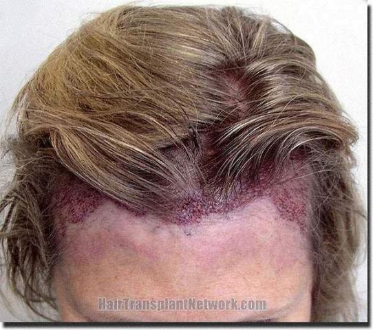 Hair restoration procedure results