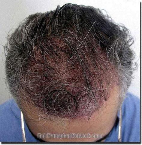 Hair restoration procedure results