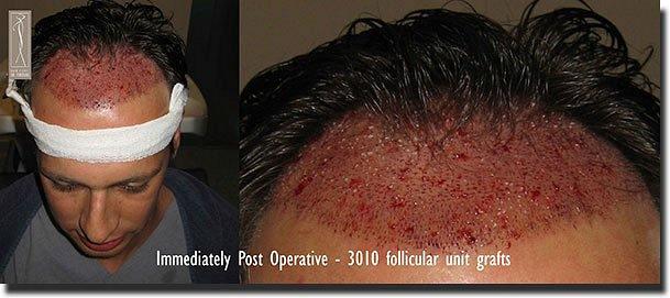 Hair restoration procedure results