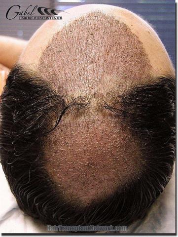 Hair restoration procedure results