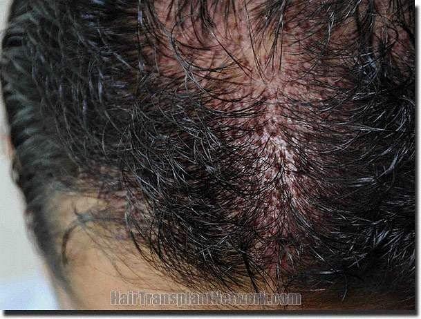 Hair restoration procedure results