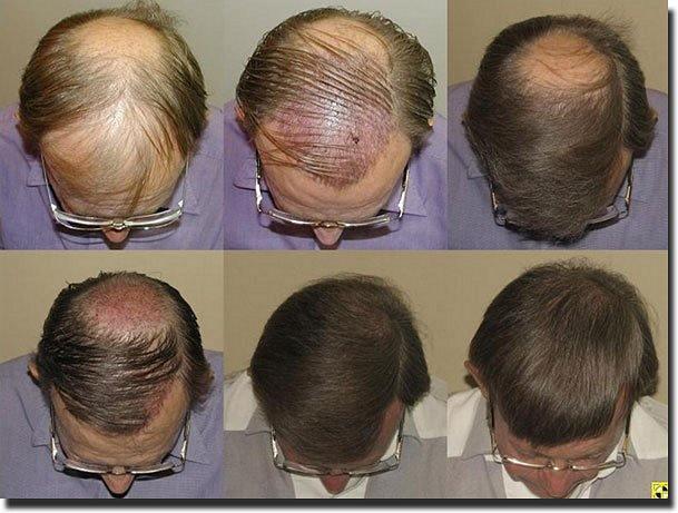 Hair restoration procedure results