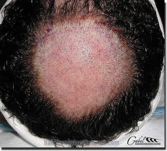 Hair restoration procedure results