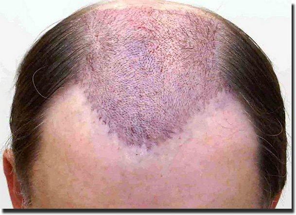 Hair restoration procedure results