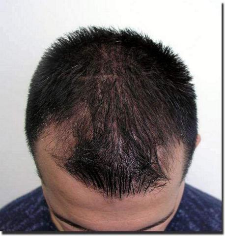 Hair restoration procedure results