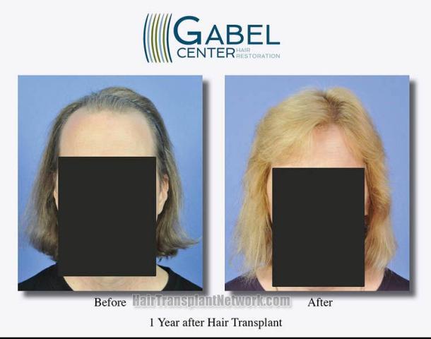 Hair restoration procedure before and after results