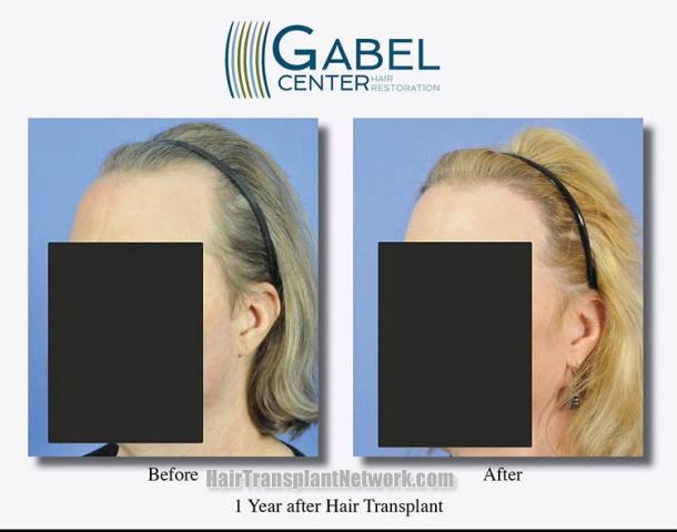 Hair transplant surgery before and after photos