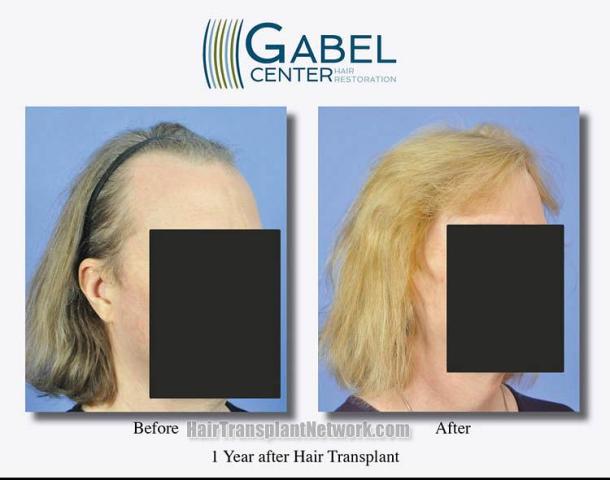 Hair transplantation surgery before and after photos