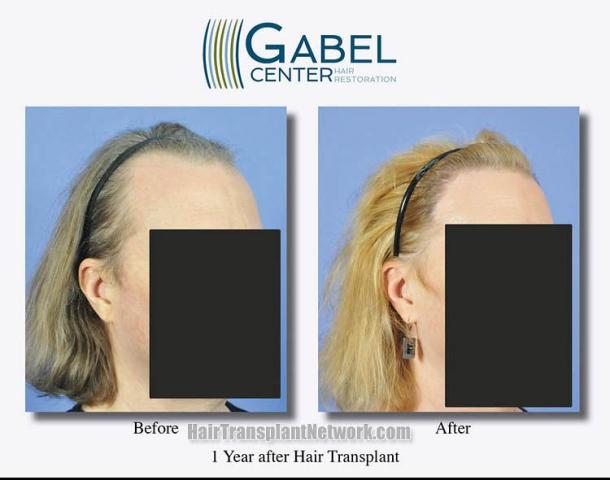 Hair restoration surgery before and after photos