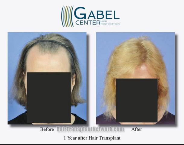 Hair restoration procedure before and after results