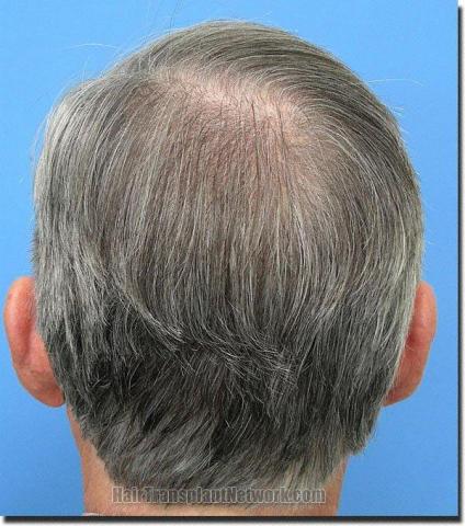 Hair restoration procedure results