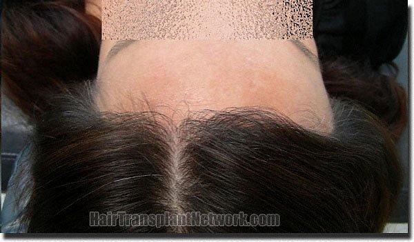 Hair restoration procedure results