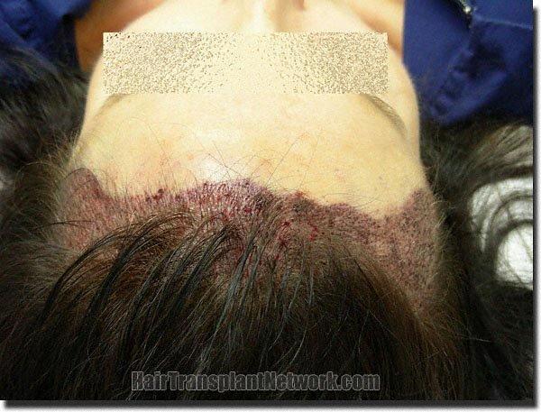 Hair restoration procedure results