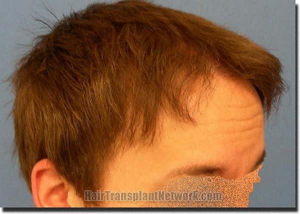 Hair restoration procedure results