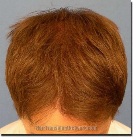 Hair restoration procedure results