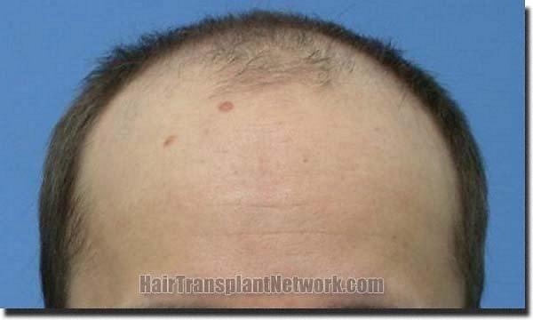 Hair restoration procedure results