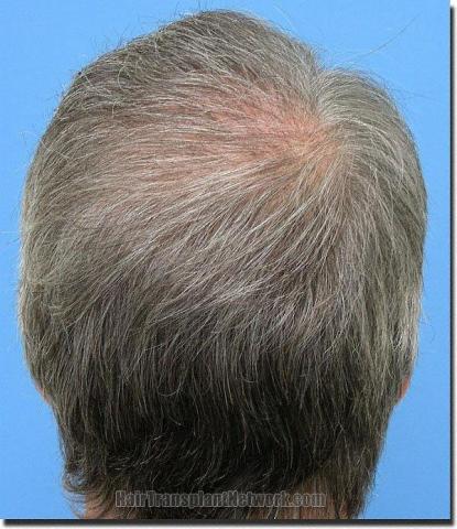 Hair restoration procedure results