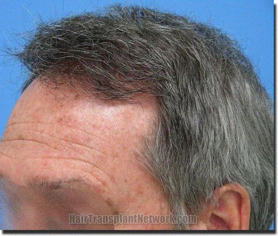 Hair restoration procedure results