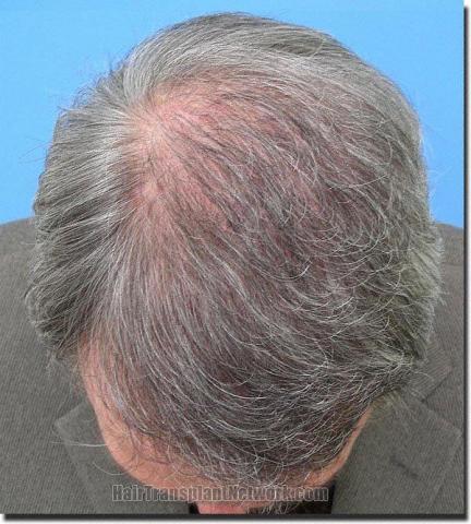 Hair restoration procedure results