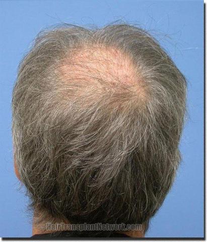 Hair restoration procedure results