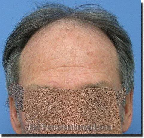 Hair restoration procedure results