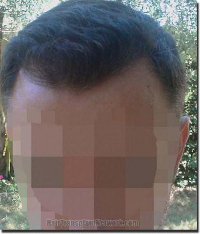 Hair restoration procedure results