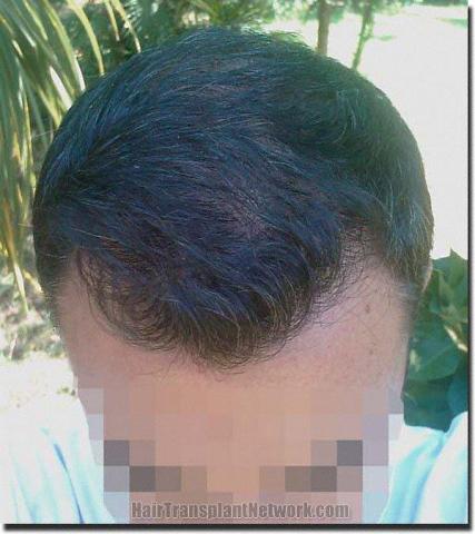 Hair restoration procedure results