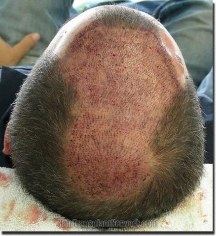 Hair restoration procedure results