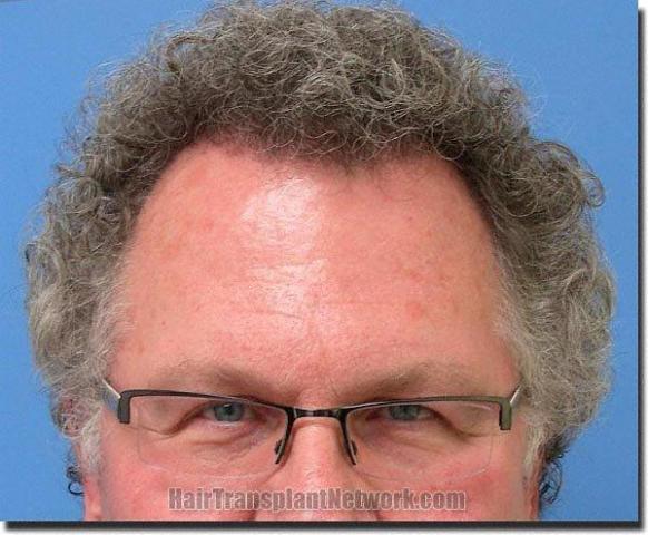 Hair restoration procedure results