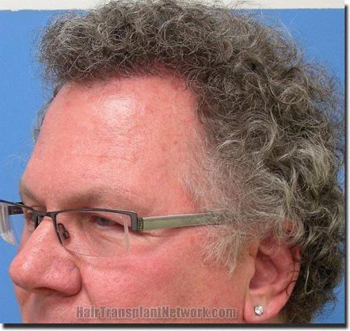 Hair restoration procedure results