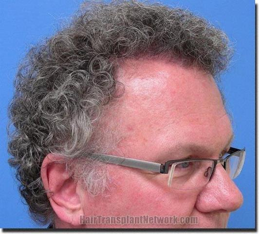 Hair restoration procedure results