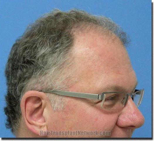 Hair restoration procedure results