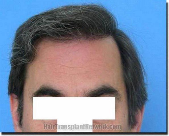 Hair restoration procedure results