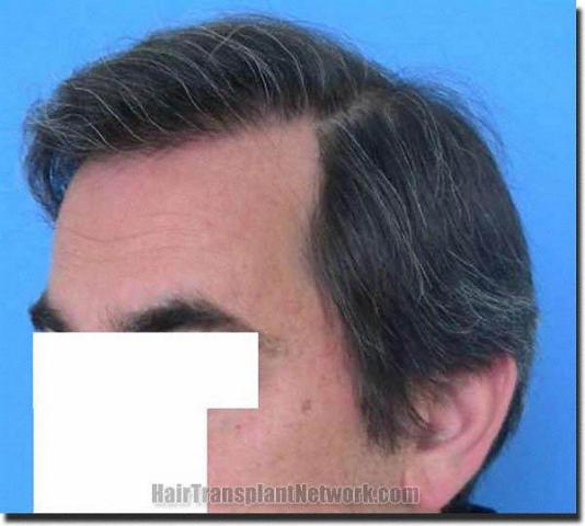 Hair restoration procedure results