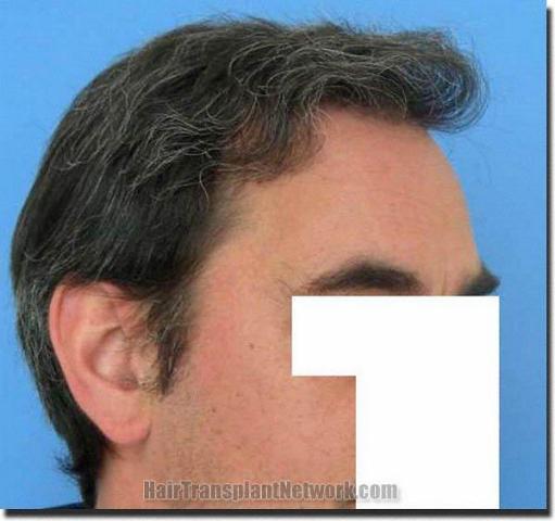 Hair restoration procedure results