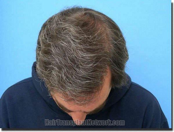 Hair restoration procedure results