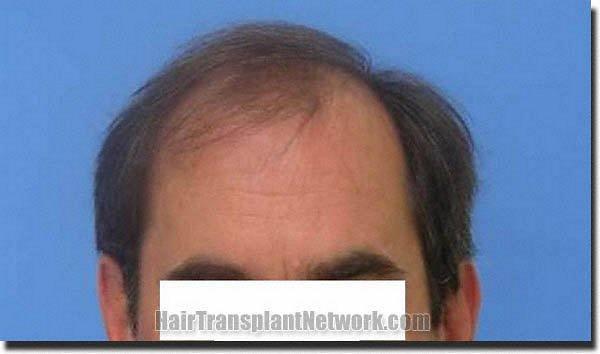 Hair restoration procedure results