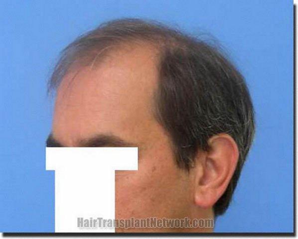 Hair restoration procedure results