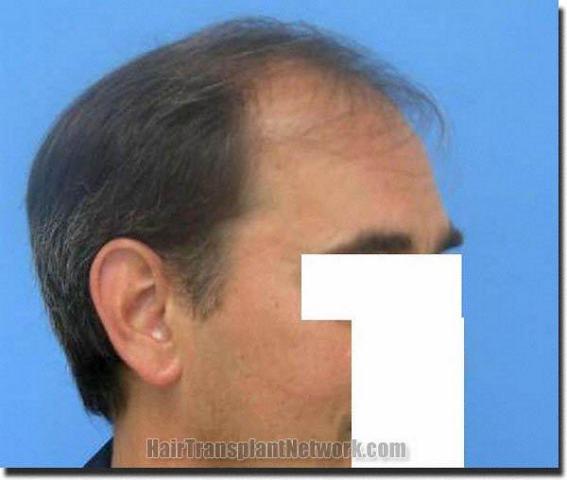 Hair restoration procedure results