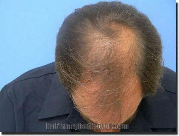 Hair restoration procedure results