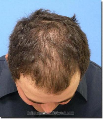 Hair restoration procedure results