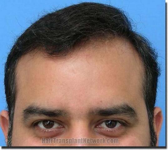 Hair restoration procedure results