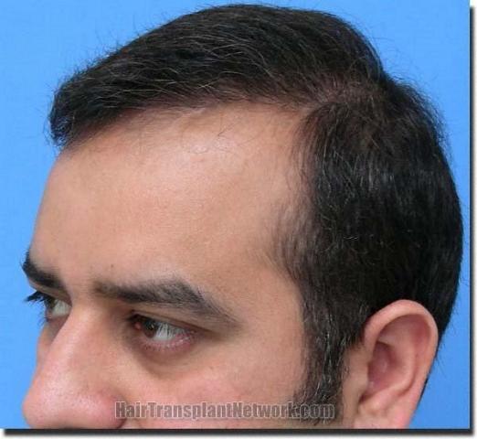 Hair restoration procedure results