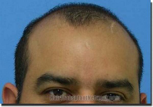 Hair restoration procedure results