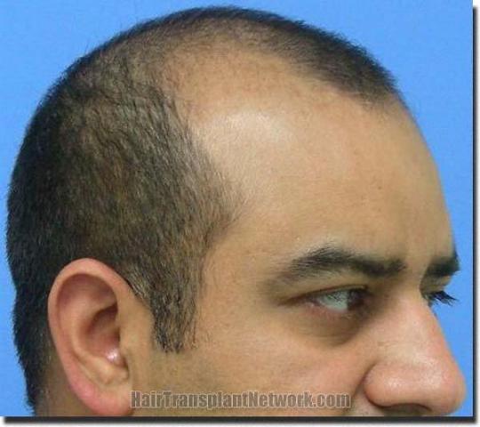 Hair restoration procedure results