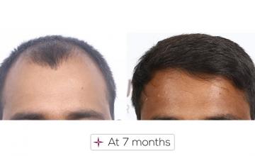 7 Month Hair Transplant Update | Grafts 2060, Norwood Grade 3A @Eugenix Hair Sciences