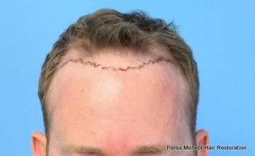 30 Year Old Male with Class IV Hair Loss by Dr. Parsa Mohebi