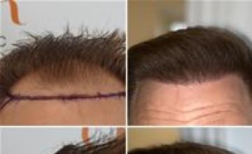 Dr. Bisanga 3,251 Grafts