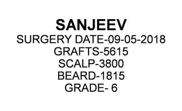 Dr Bansal & Dr Sethi | Grade-6, 5615 Grafts (Scalp+Beard) | 8 months post op